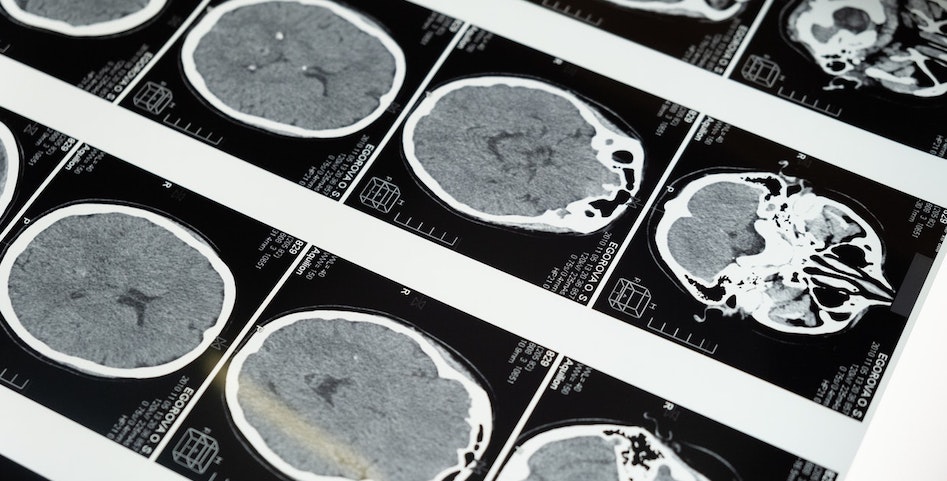 brain MRI for alcohol-induced dementia